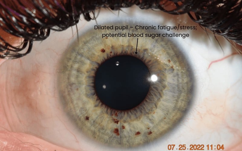 iris-examples-health-saves